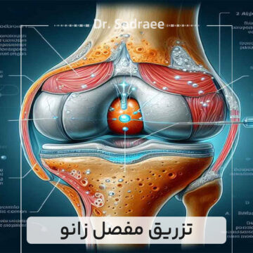 تزریق مفصل زانو